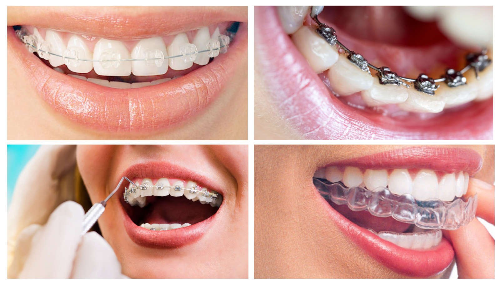 Braces
